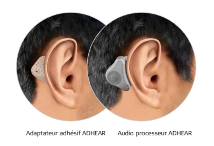 Actualité audioprothésiste audio  : ADHEAR