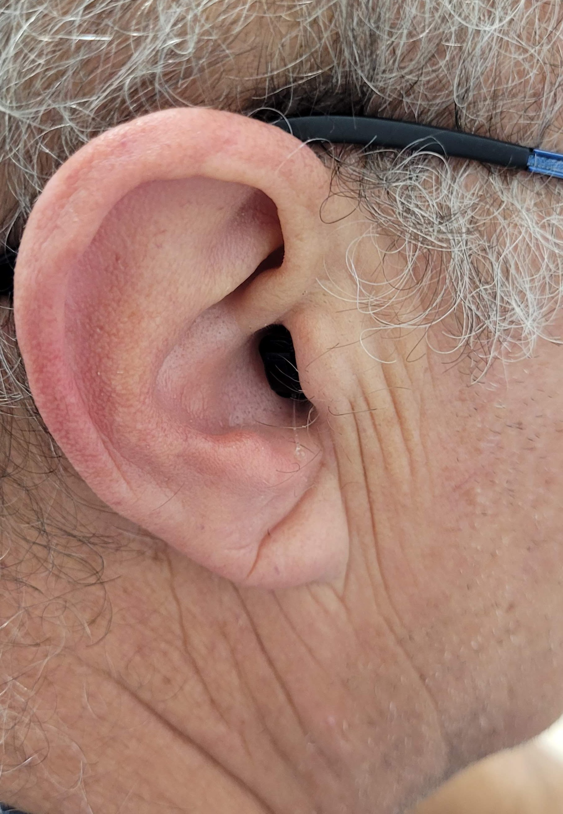 Création Exemple 3 Intra CIC visible chez L'AUDIOPROTHESISTE DIMITRI SECONDE